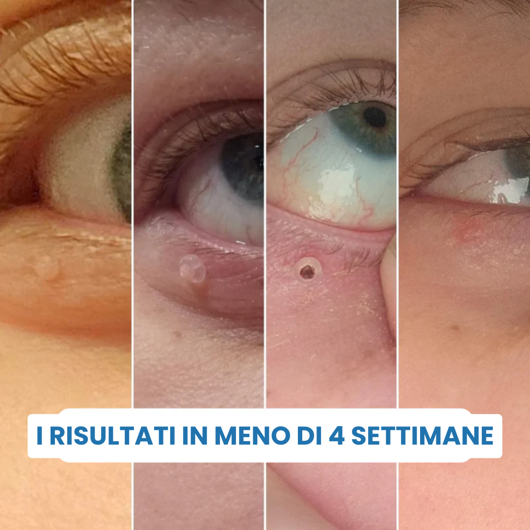 ClearTag™ - Kit per la rimozione delle escrescenze cutanee