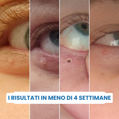 ClearTag™ - Kit per la rimozione delle escrescenze cutanee